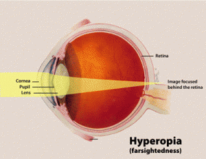 Hyperopia (farsightedness) diagram
