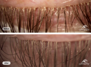 Two images of the same eye before and after ZEST treatment. The "before" eye on the left has a large buildup of demodex mites visible around the base of the eyelashes. The "after" photo on the right appears healthy.