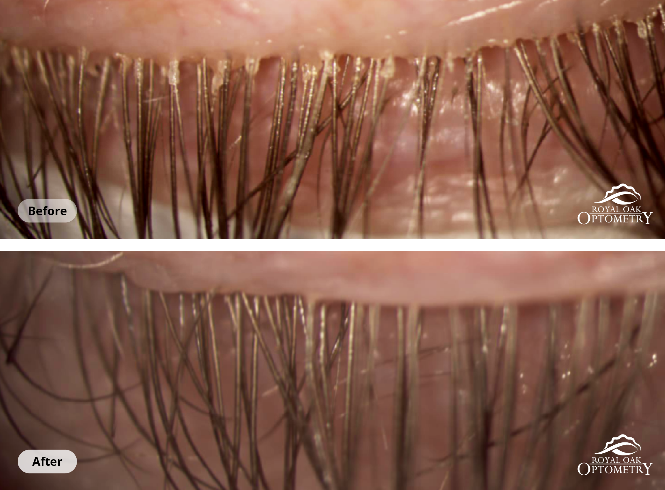 Two images of the same eye before and after ZEST treatment. The "before" eye on the left has a large buildup of demodex mites visible around the base of the eyelashes. The "after" photo on the right appears healthy.